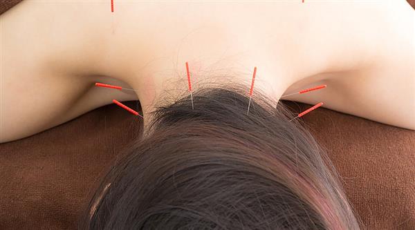 中醫(yī)針灸有何療效？石家莊炎黃針灸推拿學(xué)校為你分享！